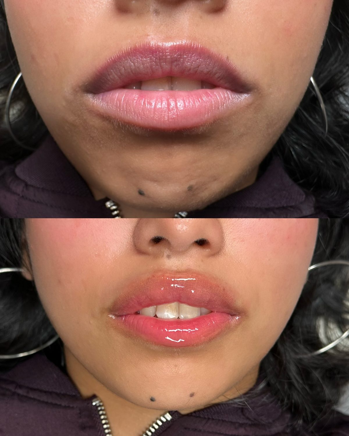 Dark Lip Neutralization before and after