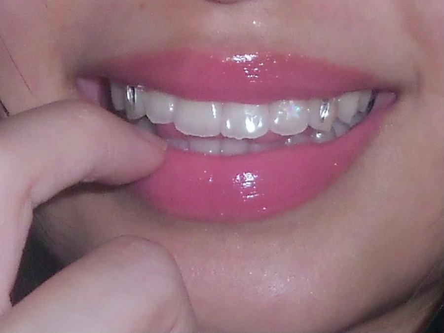 Tooth gems close up